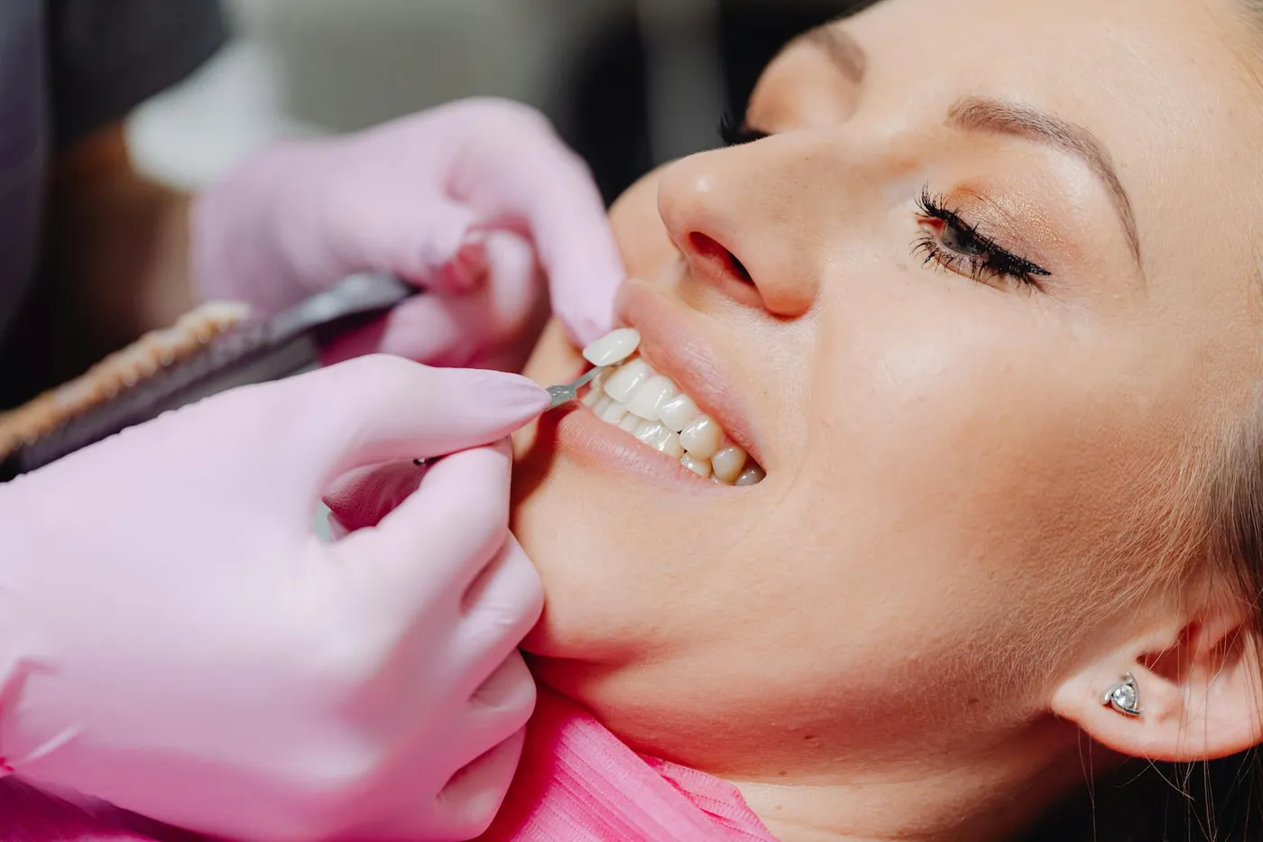 Tratamiento de estética dental y carillas en Shine Dental Room